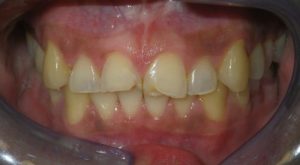 Before chipped front teeth restored with 2 porcelain crowns and bonding