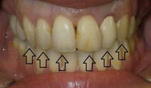Before 4 front tooth crowns and restorative treatment to the third tooth on either side