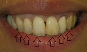 After 4 front tooth crowns and restorative treatment to the third tooth on either side