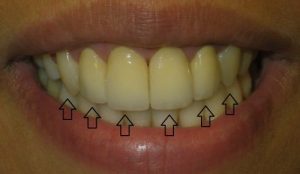 After 4 front tooth crowns and restorative treatment to the third tooth on either side