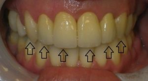 Before 4 front tooth crowns and restorative treatment to the third tooth on either side