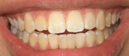 After single implant with two teeth, Aesthetic challenge turns out beautifully