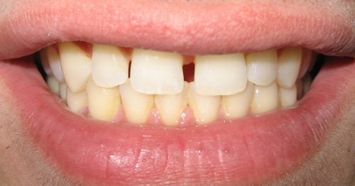 Before Veneers to close gaps.
