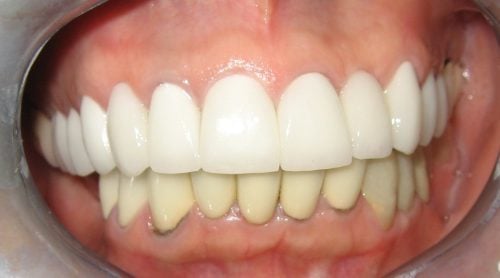 After: Replaced with full porcelain crowns -bleached white -full upper