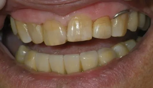 Custom Staining 1 Upper front tooth: second to right-centre tooth