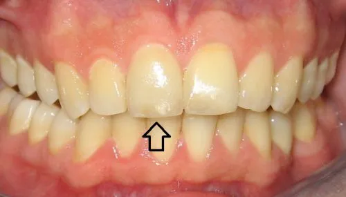 After Upper front tooth crown and Bonding on right-centre tooth