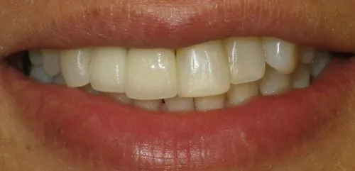 Single tooth implant - Perfect match: upper left