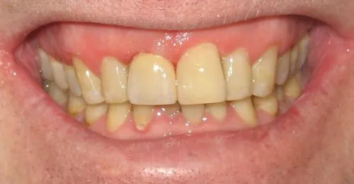 After one Crown and bonding by Thornhill Dental