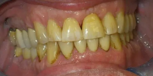 In-Office Custom Staining upper front tooth right center. View #2
