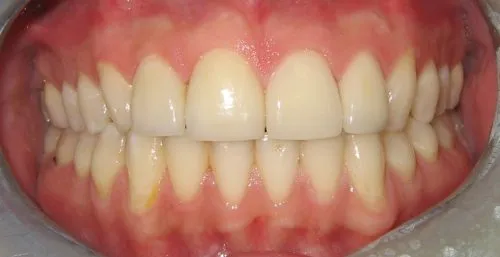 Smile showing 4 Veneers: Front teeth