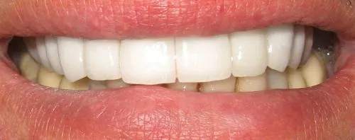 After Full porcelain replacement crowns #2