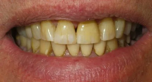 In-Office Custom Staining upper front tooth right center.