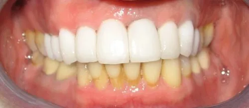 After Full porcelain replacement crowns