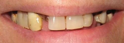 Crowns and removable attachment partial dentures with hidden clasps Before #1