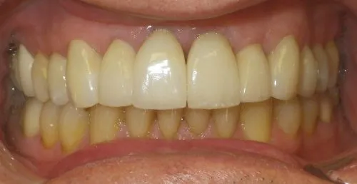 After Full Porcelain Crowns by Thornhill Dental