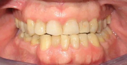 Before 6 Veneers: Upper front teeth