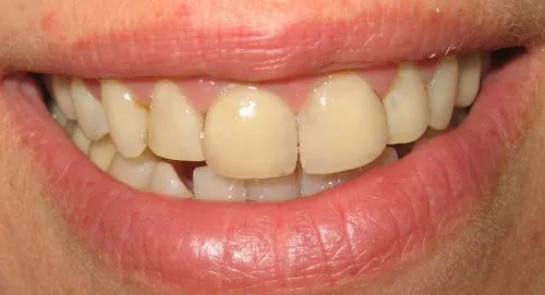 Before 7 Upper porcelain crowns by Thornhill Dental