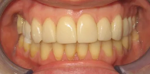 4 Veneers: Upper front teeth