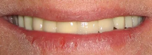 Crowns and removable attachment partial dentures with hidden clasps After 1