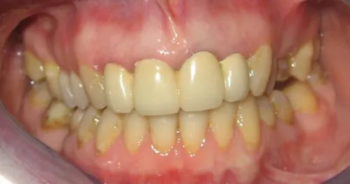 Before Replacement upper bridgework, with all porcelain crowns