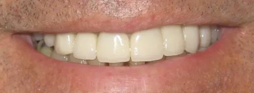 Full upper porcelain crowns including two dental implants After 1