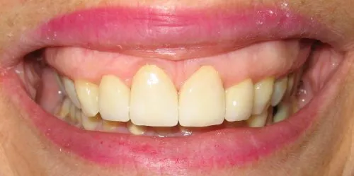 After 4 Front teeth crowns
