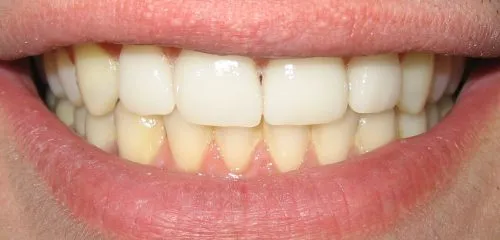 After Veneers to close gaps.