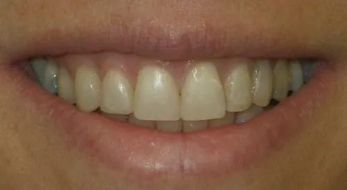 Afetr In-office direct bonding: 6 front teeth