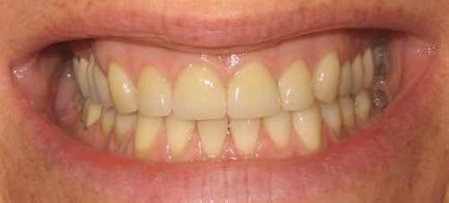 After 4 Veneers: Upper front teeth