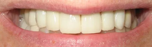 Full upper porcelain crowns