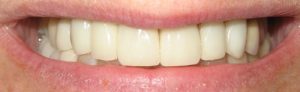 Full upper porcelain crowns
