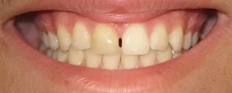 Old bonding and large gap repaired with an all ceramic crown and in-office customization - Before