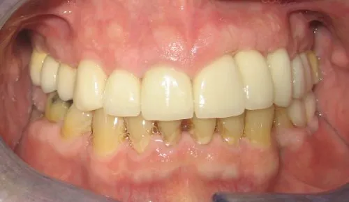Full upper porcelain crowns including two dental implants After 2
