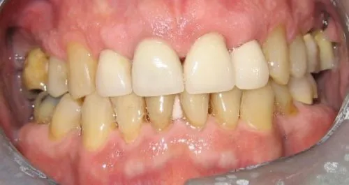 Full upper porcelain crowns including two dental implants Before #2