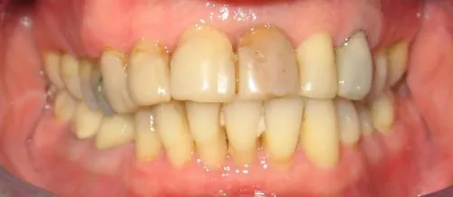 Before Full porcelain replacement crowns