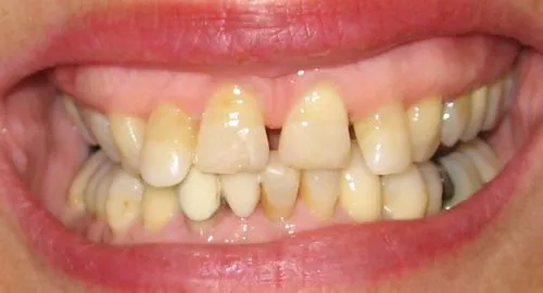 Before 4 Front teeth crowns