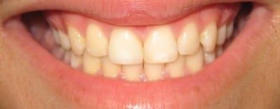 Old bonding and large gap repaired with an all ceramic crown and in-office customization - After