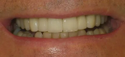 Before Full Porcelain Crowns by Thornhill Dental