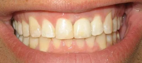 After Replacement of old crown with an all-ceramic crown, and in-office customization