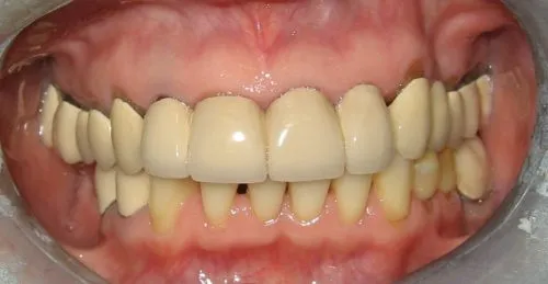 Before Replacement upper crowns