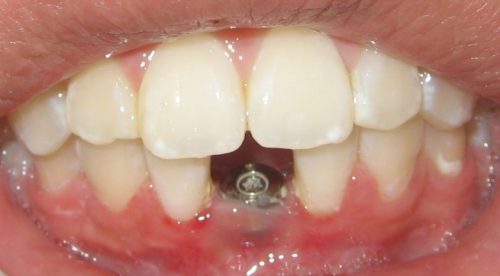 Before Single implant, two teeth
