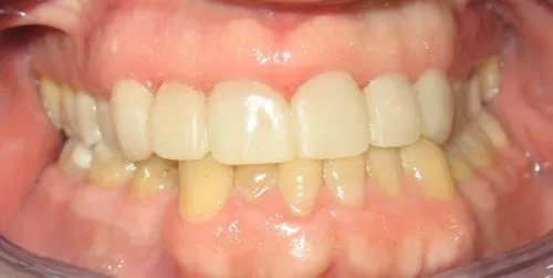 After 6 Veneers: Upper front teeth