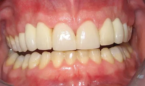 After Full upper porcelain crowns and bridges
