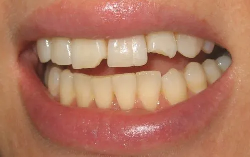Before upper veneers and crowns by Thornhill Dental