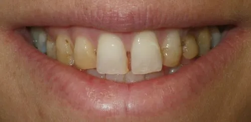 Before in-office direct bonding to 6 front teeth.