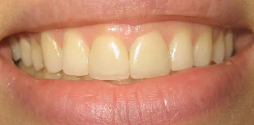 Smile showing Two Front Veneers