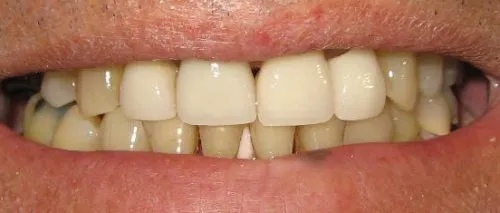 Before 1 - Full upper porcelain crowns including two dental implants