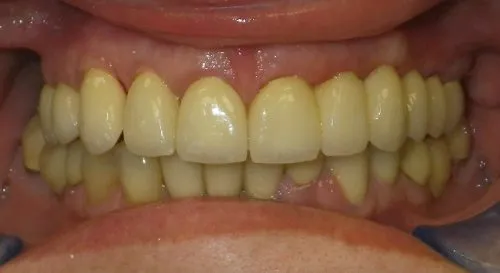 Full upper crowns by Thornhill Dental