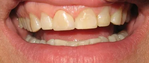 In-Office Custom Staining front left center tooth.
