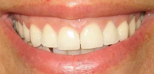 After 7 Upper porcelain crowns by Thornhill Dental